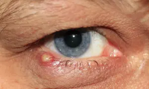Zbliżenie na niebieskie oko z widocznym ropniem na powiece przy rzęsach.