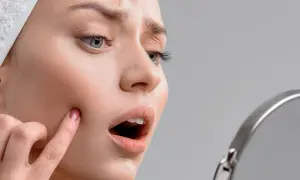 Kobieta z przerażeniem patrzy w lustro na drobne krostki i zaczerwienienia, objawy podrażnienia po depilacji woskiem.