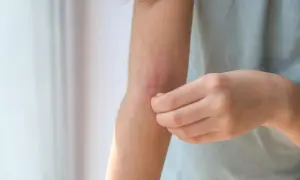 Ramię z zaczerwienioną, łuszczącą się skórą, osoba drapie się po swędzącym miejscu.