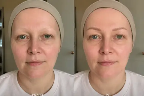Porównanie twarzy przed i po odzyskaniu brwi po chemioterapii.