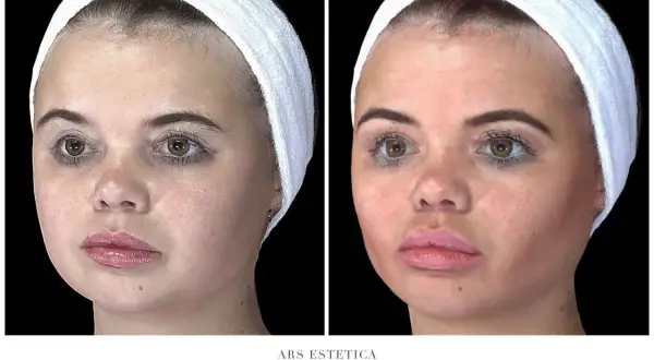 Dwa zdjęcia twarzy kobiety w opasce: przed i po zabiegu.