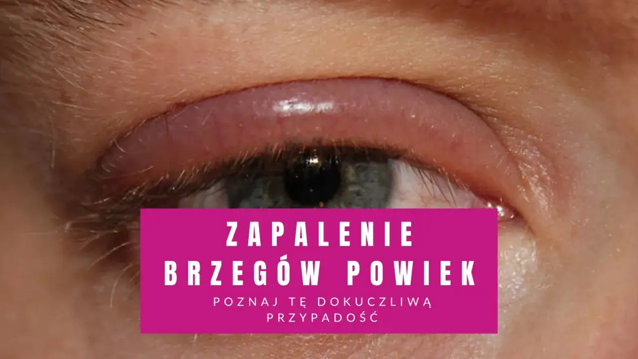 Zapalenie brzeg&oacute;w powiek, często spowodowane przez bakterie na rzęsach, objawia się zaczerwienieniem i obrzękiem.